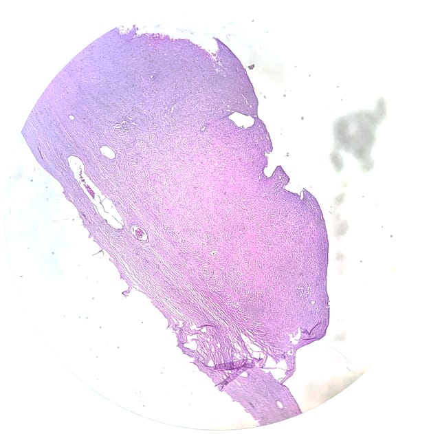 Muestra microscópica de tumores serosos del ovario