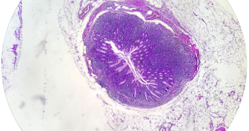 Inclusiones benignas en ganglios linfáticos