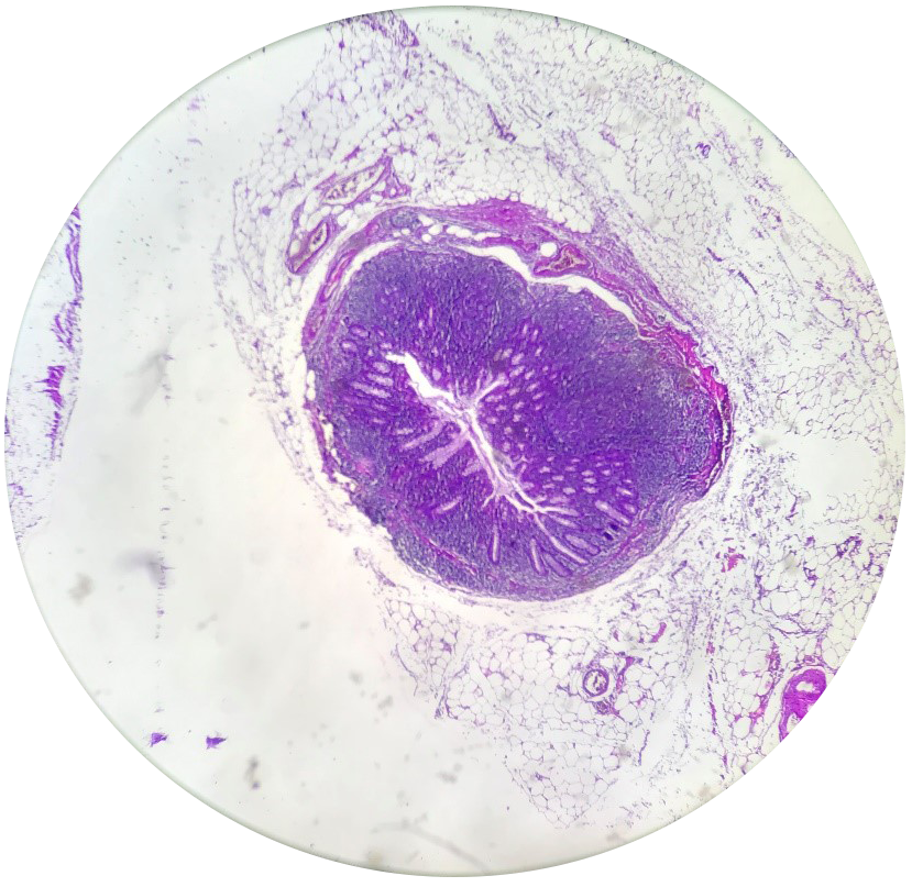 Inclusiones benignas en ganglios linfáticos